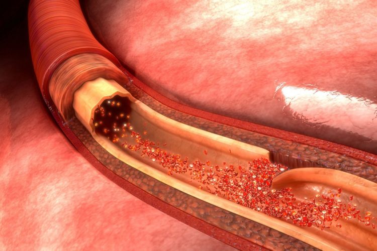 Non Invasive Test To Check Arteries