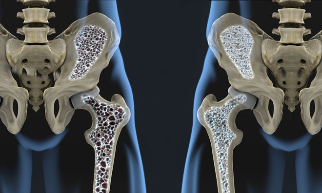 UCB and Amgen’s Osteoporosis study shows bone mineral density gains