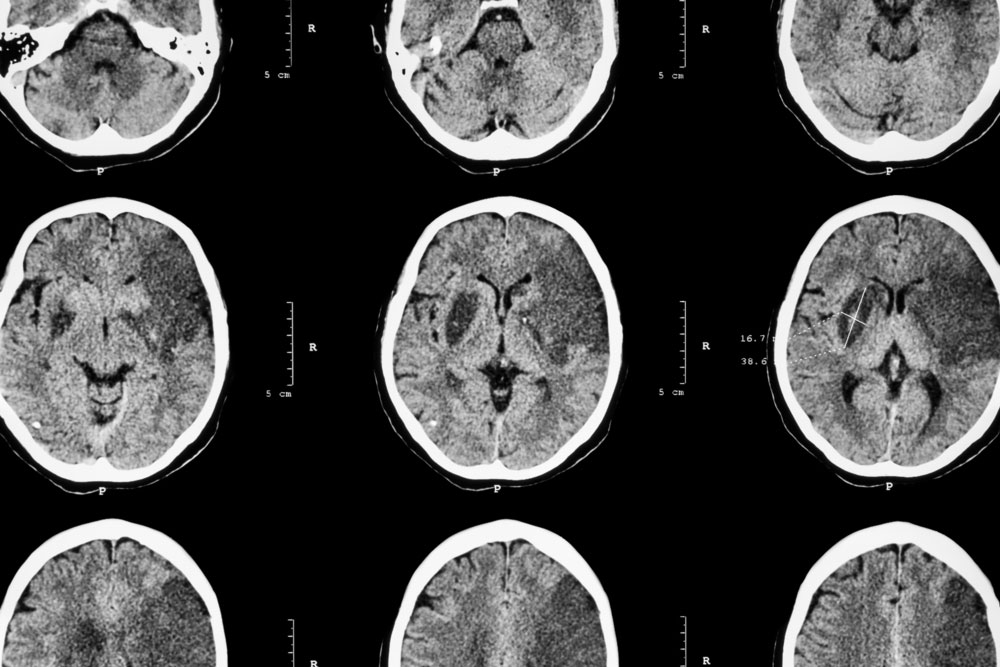 3k3a-apc-demonstrates-safety-in-clinical-trial-for-acute-ischemic-stroke