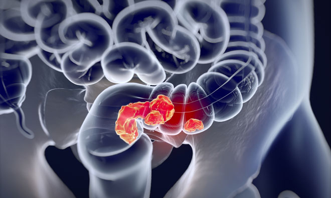 Breakthrough designation for Keytruda in colorectal cancer