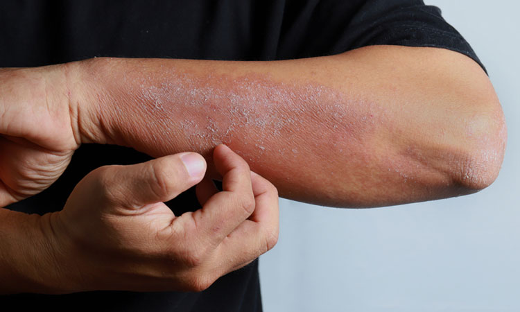 Investigational cream could help patients with atopic dermatitis