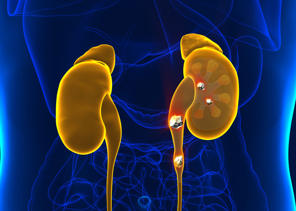 oral-antibiotics-may-raise-risk-of-kidney-stones-epr