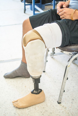 Pioneering treatment could freeze out phantom limb pain