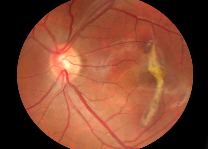 Stem cell therapy shows promise for macular degeneration